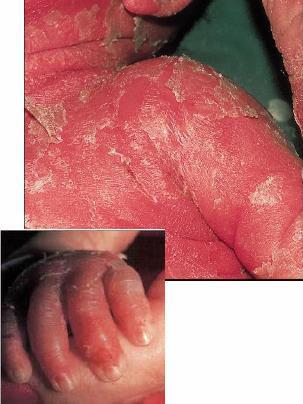 Staphylococcal scalded skin syndrome - Pemphigus neonatorum - most often occurs in infants - low
