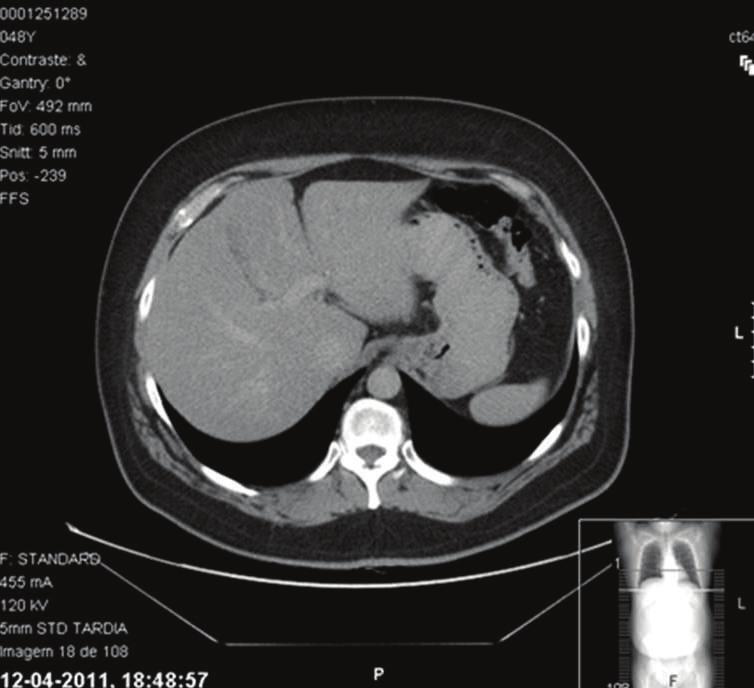 Case Reports in Surgery 3 Figure 2: Tumor staging.
