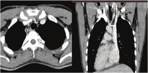 [Table/Fig-4]: a) Axial CECT image shows branches of arch of aorta as 1- Left brachiocephalic artery, 2-Common carotid artery and 3Right subclavian artery.