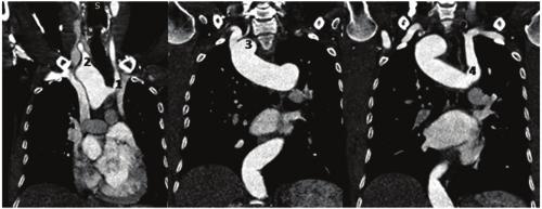 There was also suprasinus origin of coronary arteries [Table/ [Table/Fig-8a,b]: Coronal and Axial CT angiography images showing right aortic arch crossing midline posteriorly to descend on the left
