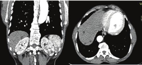 [Table/Fig-11a,b]: Coronal and axial CT angiography images showing multiple non enhancing cystic lesions in bilateral kidneys and liver. Fig-10a].
