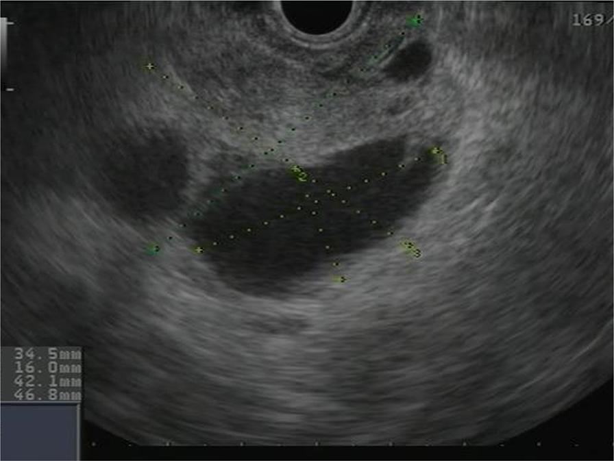 Endoscopic ultrasound demonstrated a hypoechoic lesion measuring 42 47 mm in the head of the pancreas with regular borders and large cystic components (Figure 2).