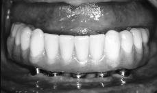 Fig 1 A hybrid denture is fabricated over a metal framework and retained by screws threaded into the implant abutments.
