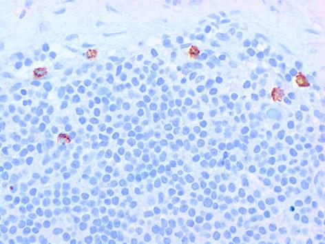 positive macrophages in SLN