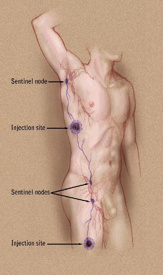 N-category determined by sentinel node evaluation in most cases Most lymph node metastases are detected by examination of the sentinel lymph node.