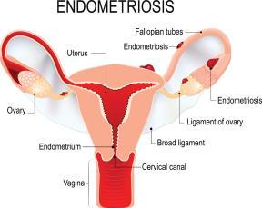 related to elevated insulin levels and over production of testosterone 8 ANATOMICAL ABNORMALITIES: ENDOMETRIOSIS (8,9) Condition when