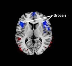 Broca s Aphasia People are aware of their deficits ( hear themselves) Theory: Broca s Area controls motor programs for word production Control of tongue, throat, muscles,jaw, lips Other areas