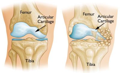 Knee osteotomy is used when you have early-stage osteoarthritis that has damaged just one side of the knee joint.