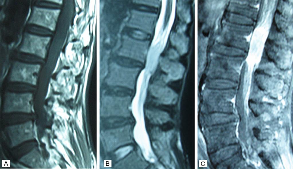 imaging; C: Significantly homogeneous enhancement on MRI enhancer. Figure 2.