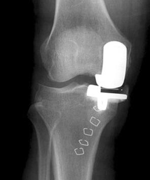 symptoms. (B) A 3-phase bone scan of the right knee showed some increased radioisotope uptake on all three phases.