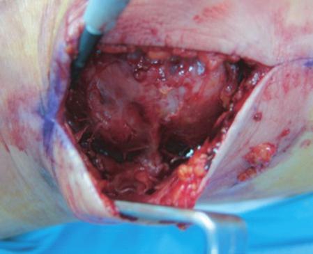 3). In another case, suprapatellar bursitis developed, and bursectomy of the suprapatellar bursa was performed (Fig. 4).
