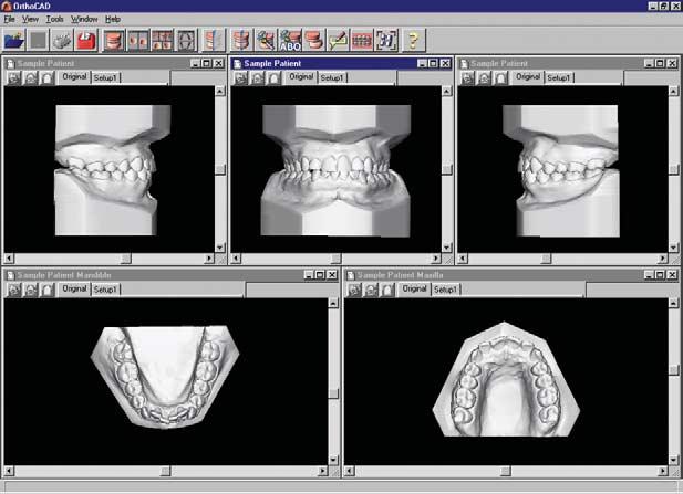 102 Santoro et al American Journal of Orthodontics and Dentofacial Orthopedics July 2003 The study sample to compare plaster and digital models was selected randomly from the patient records at the