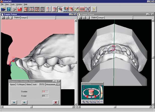 Tooth size measurement tools (mesiodistal diameters) in OrthoCAD. Mand R first molar.0001* 0.3053 Mand R second premolar.0003* 0.2138 Mand R first premolar.0001* 0.3066 Mand R canine.0001* 0.2888 Mand R lateral incisor.