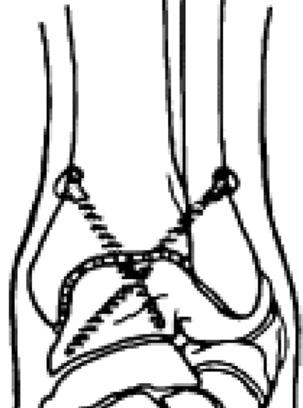 FIGURE 3 Illustration, anterior-posterior view of ankle anteriorposterior weightbearing x-ray with two crossed fixation compression screws.