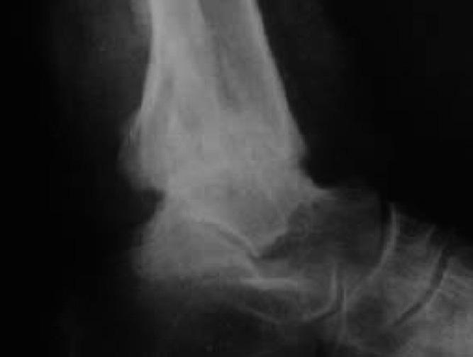 FIGURE 11 Lateral ankle weightbearing x-ray, 36 months post operative film.