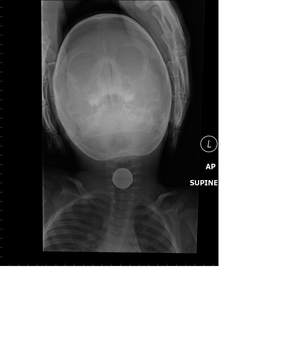 Figure 1. Lateral and Frontal View of Ingestion of a disk battery. Note the two-step pattern on the lateral radiograph and the double circle pattern in coronal plane on the frontal radiograph.