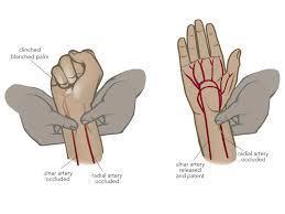 Allen Test Used to evaluate arterial supply to the hand Must be done to assess ulnar artery
