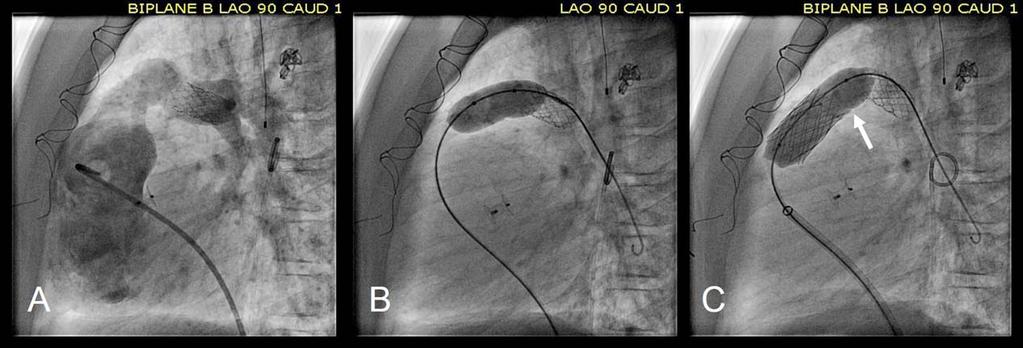 220 Kobayashi et al. Fig. 1. Straight lateral projection at the initial stent deployment. A: Angiography in the RV shows stenotic pulmonary conduit with the narrowest site measuring 12.5 mm.