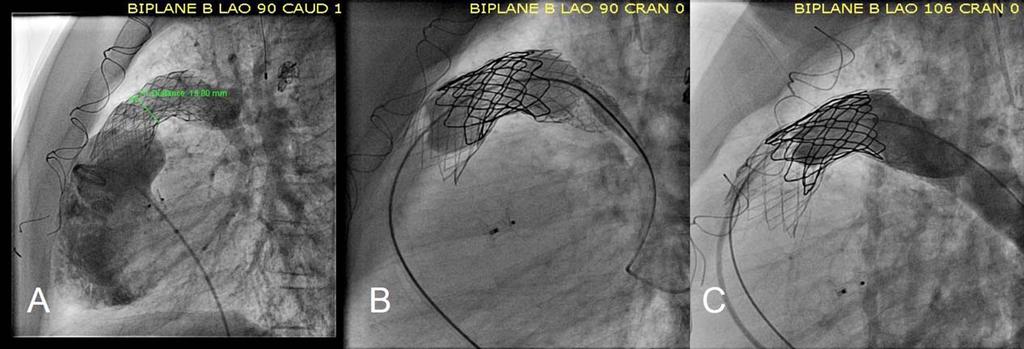 B, C: While the embolized stent is held in the proximal conduit with an assist of inflated Tyshak II balloon catheter, a second stent is carefully positioned and deployed successfully; it adheres