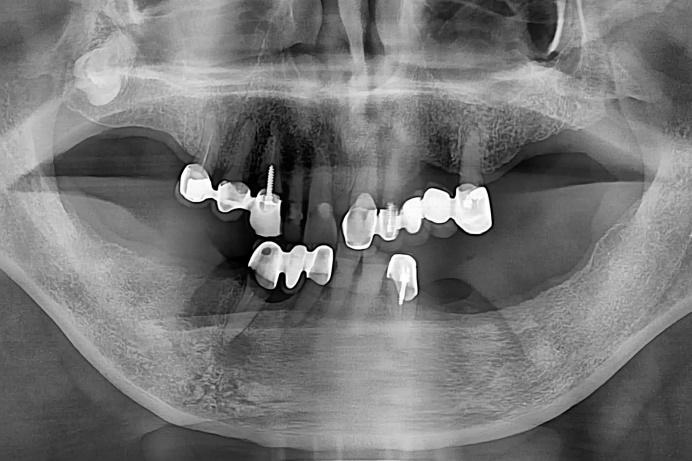 Figure 4. Panoramic X-ray and a Photo taken on the first visit He already knew that those teeth needed to be extracted at that time.