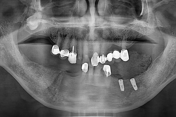 Implants were placed on #34, #35 position. On the first treatment day, as planned, #41 and 43 were extracted and two implants were placed on the left side of lower jaw.