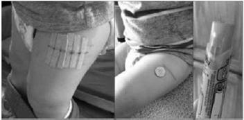 Intense vasoconstriction (in digits) 97 98 Strategies for Safe and Effective Use of Injectable Epinephrine Auto-injectors may only be given IM (preferred) or SQ Inject into anterolateral aspect of