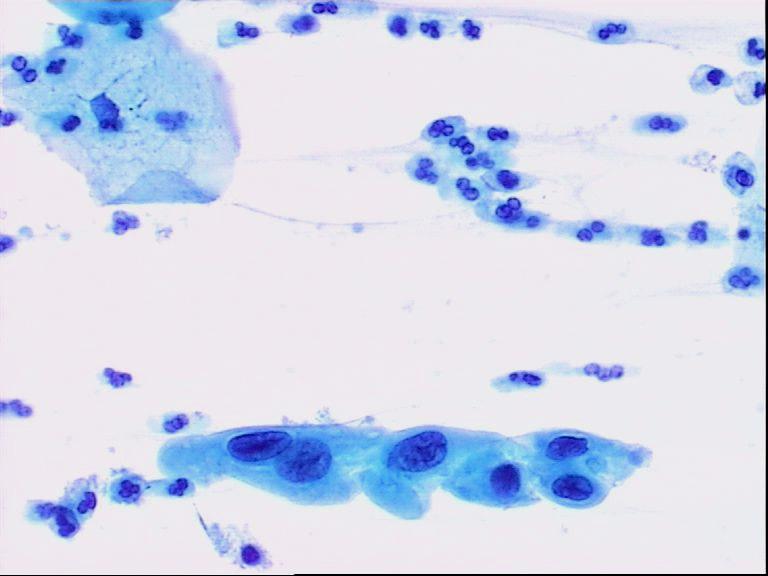nazivlja i klasifikacije intraepitelnih lezija pločastog epitela