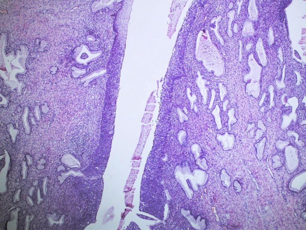 Mikropreparaat Gy44. Dysplasia epithelii gravis (CIN III) Emakakaela konisaadis.