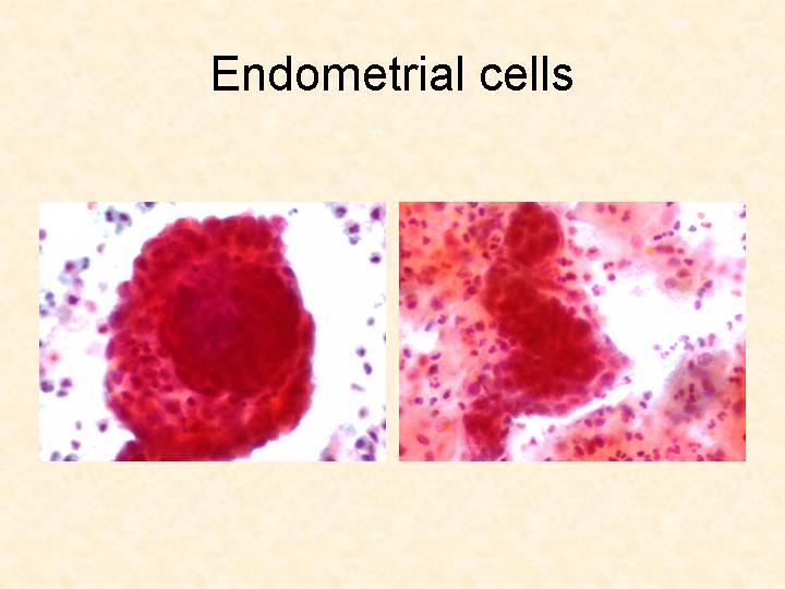 Normally shed endometrial cells: N.B.