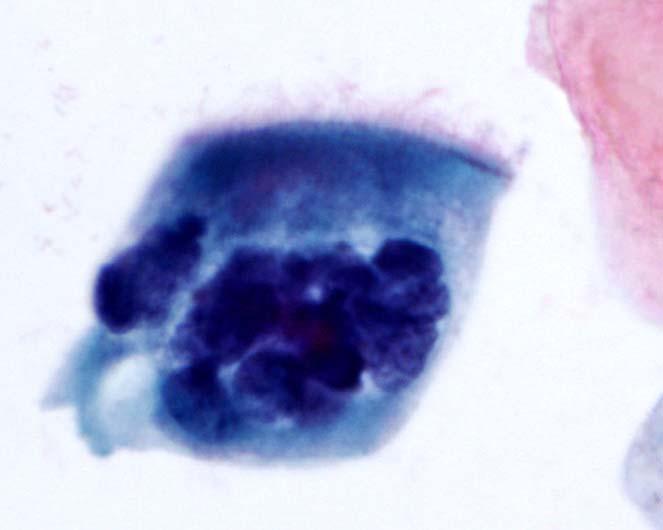 Tubal metaplasia Pseudostratified dark nuclei