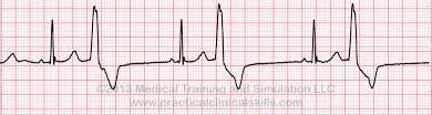 BRADYCARDIA TACHYCARDIA Heart Rate less than 60 bpm Heart Rate greater than