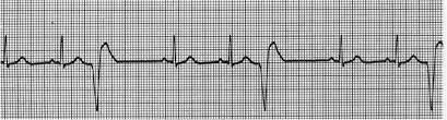 Contraction (PVC) Most common of the ventricular arrhythmias QRS duration
