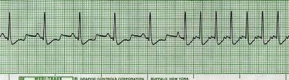 VENTRICULAR TACHYCARDIA VENTRICULAR TACHYCARDIA A run of three or more PVCs Usually has a rate between 120 200 bpm Premature Atrial Contraction (PAC) Premature Atrial Contraction (PAC) PACs are