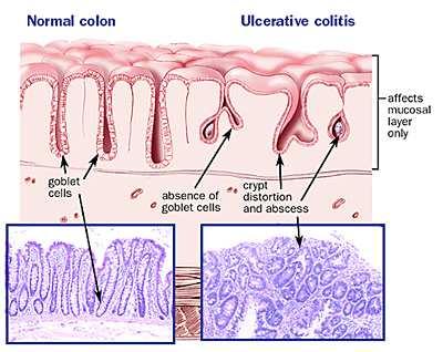 Histologic Features of Ulcerative Colitis Ulcerative
