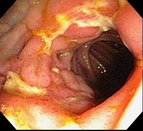 Rectal bleeding and anal ulcers Stunted growth in