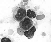 Trombocitopenija KRONIČNA LEVKEMIJA Močno zvečano število levkocitov