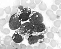 ali t(16;16) z c-kit mutacijo neopredeljena kot ugodna ali neugodna Osnovni imunofenotip levkemičnih celic pri AML in ALL