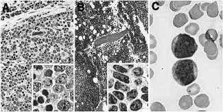 11.9.2014 Agresivna NK celična levkemija Sistemska proliferacija NK celic Skoraj vedno vezana na EBV okužbo Azijci, mladi odrasli cca 40 let Periferna kri, kostni mozeg, jetra, vranica Celice imajo