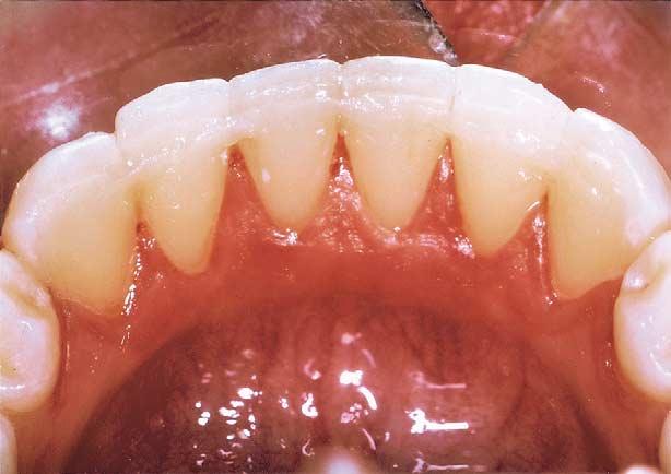 A, Placement of polyethylene fiber material; B, occlusal view of finished space maintainer. 2), the embrasures were shaped to facilitate good oral hygiene, and the composite was polished.