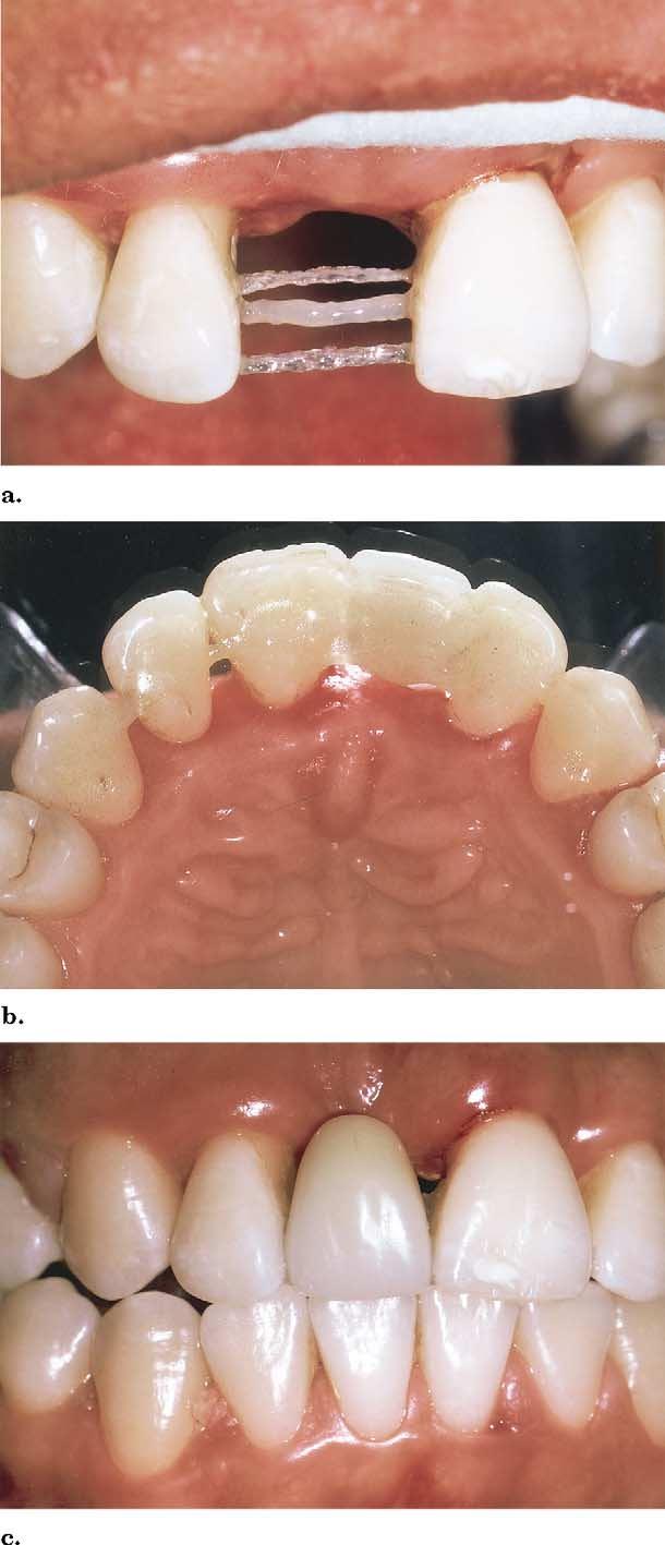 652 Karaman, Kir, and Belli American Journal of Orthodontics and Dentofacial Orthopedics June 2002 Fig 4. Ribbond used as temporary esthetic retention appliance.