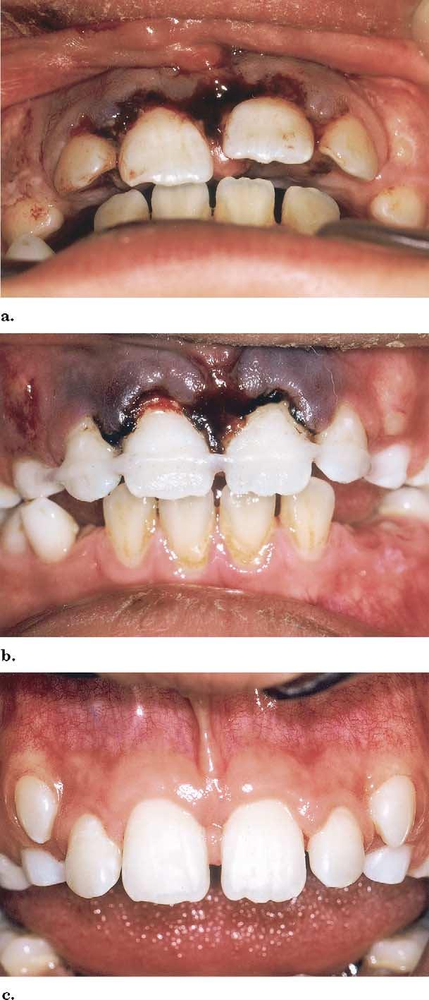 Ribbond used in posttraumatic stabilization splint. A, Traumatized anterior segment; B, teeth stabilized with polyethylene fiber material; C, frontal view after healing.