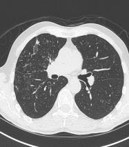 Nodular Bronchiectasis Nonresolving infiltrates Bronchiolitis/ tree in bud Waxing and waning infiltrates and nodules Mucus plugging Female predominant Older age Low body mass index Nonsmokers