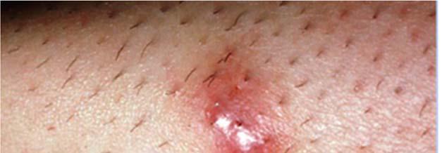 the hair, hair follicles, and the surrounding dermis resulting in a