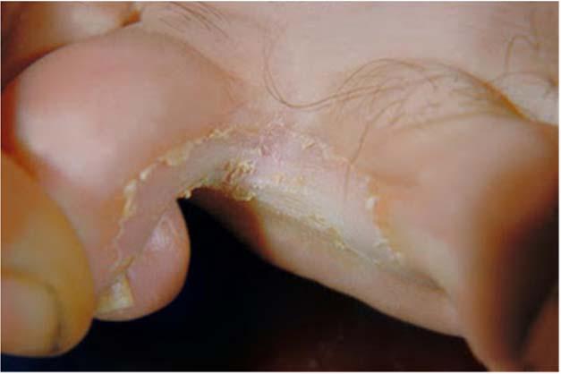 9 Medical Topics - Tinea Treatment: Topical antifungal creams should be tried first to treat superficial localized fungal