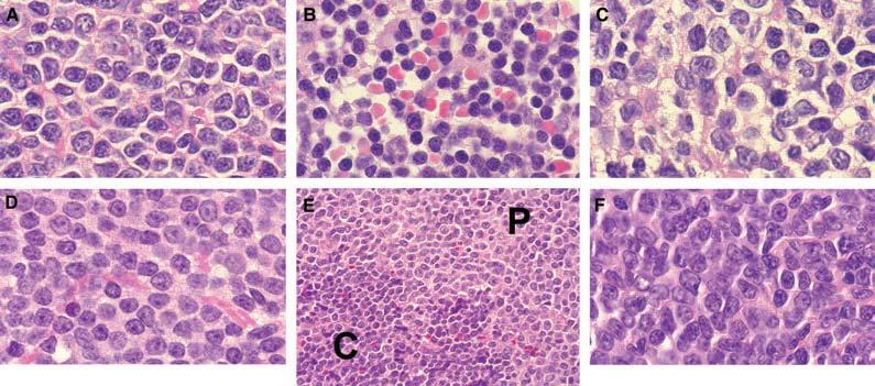 Cytological variants of Mantle Cell Lymphoma.