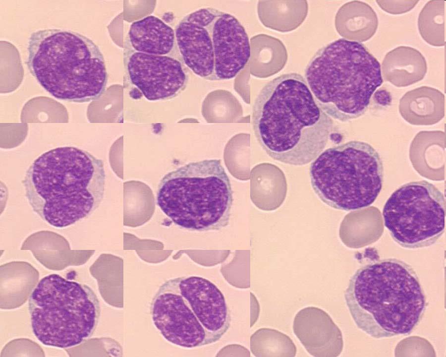 Leukemic phase of mantle cell lymphoma. Peripheral blood. Small to medium sized lymphoid cells with slightly to markedly irregular nuclear contour.