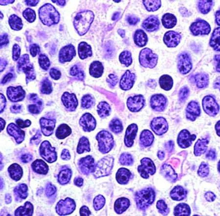 Diagnosis: Mantle Cell Lymphoma