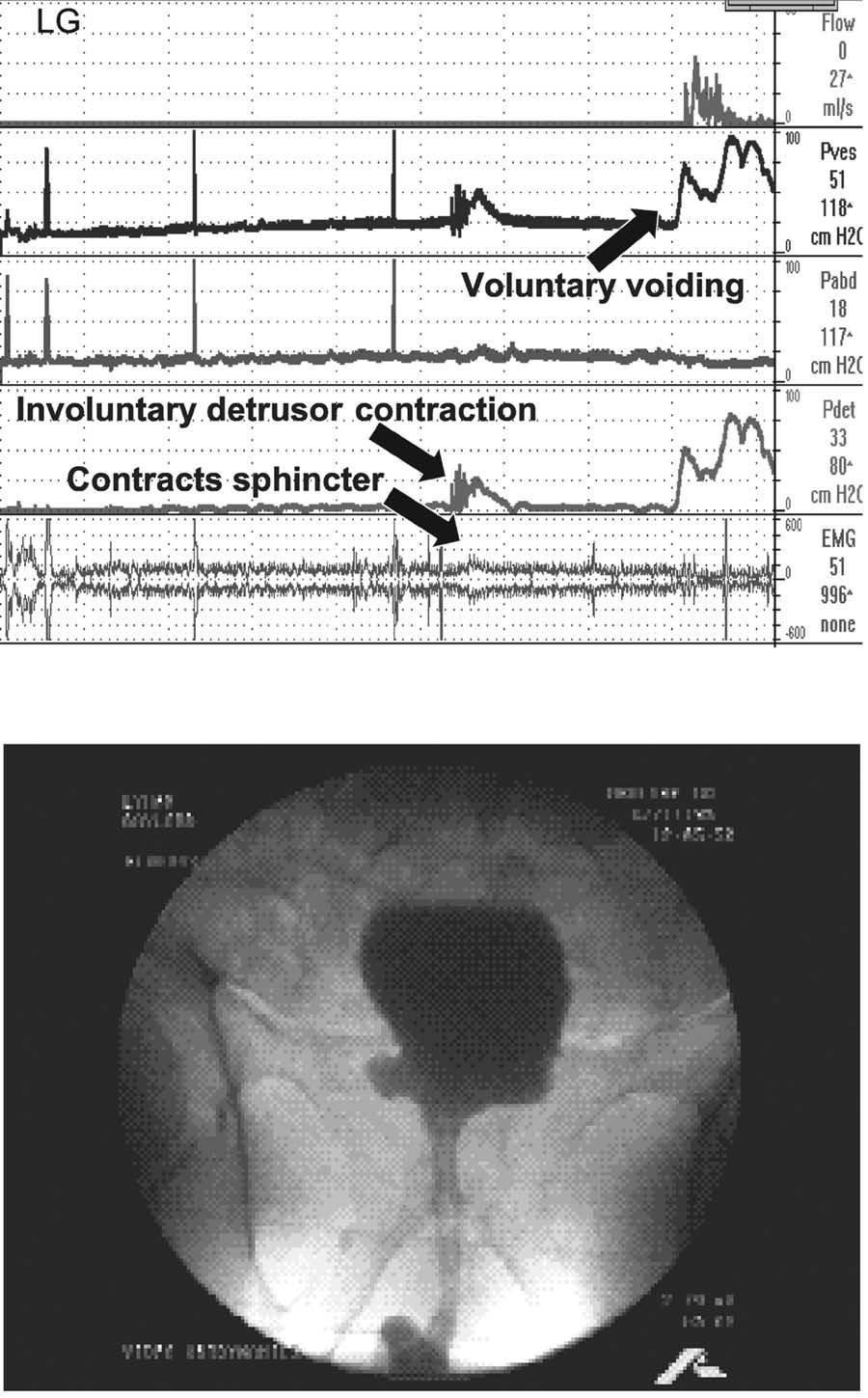 FIGURE 3. Involuntary detrusor contractions and normal control in a man with benign prostatic hyperplasia and prostate cancer without urethral obstruction.