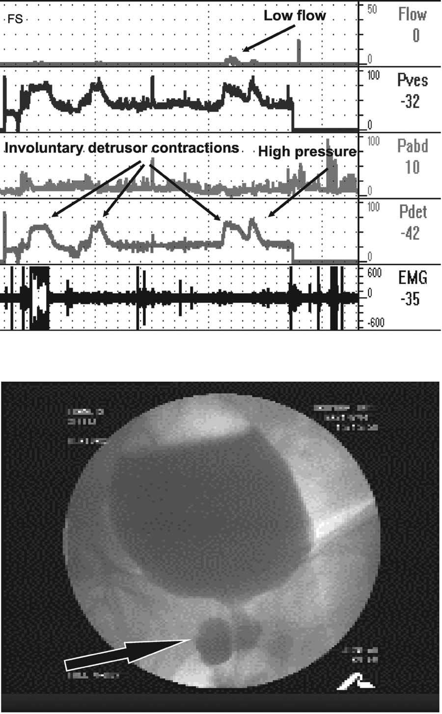 FIGURE 5. Involuntary detrusor contractions in a woman with obstruction caused by a large, multiclocular urethral diverticulum.