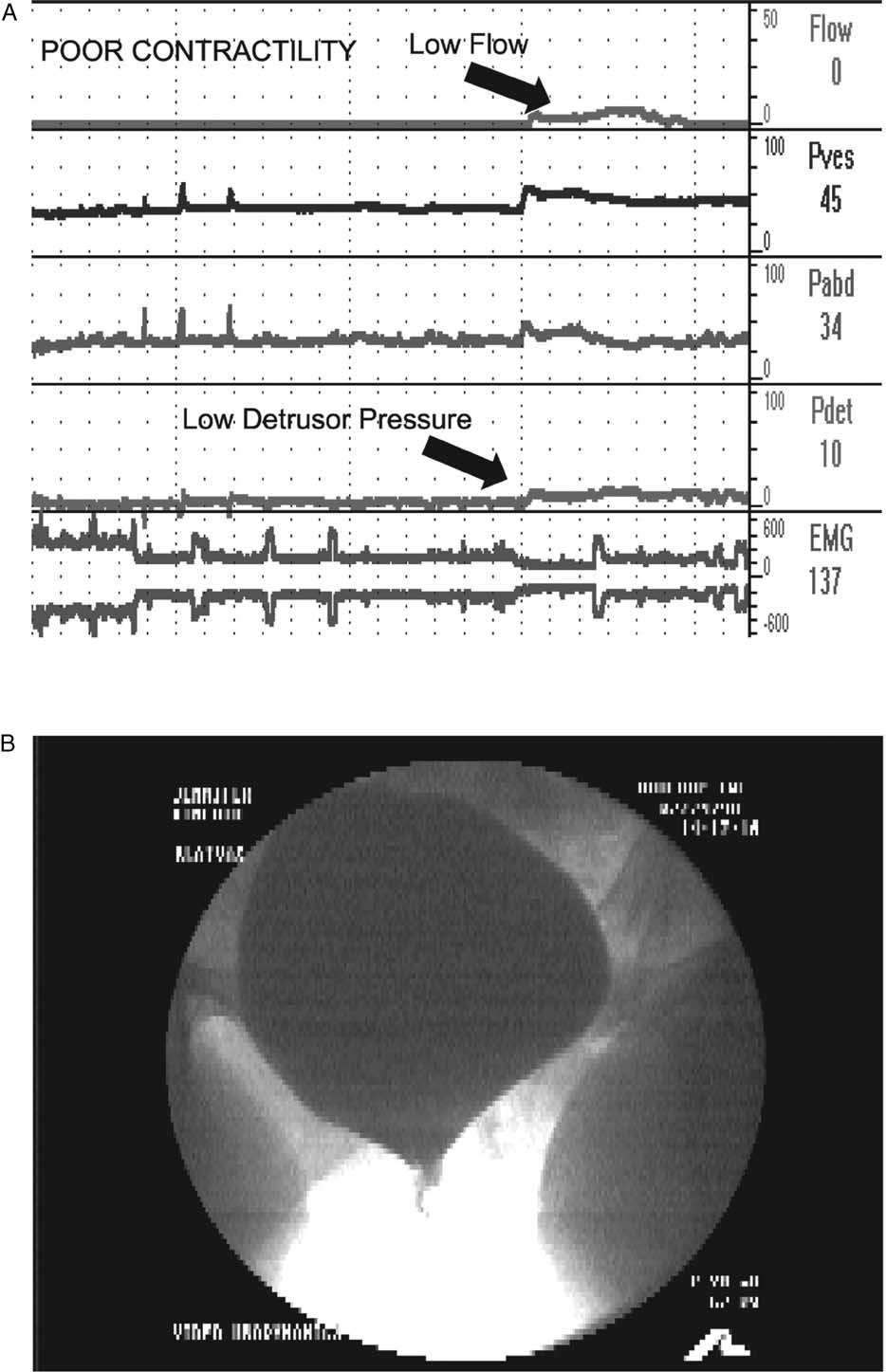 FIGURE 6. Involuntary detrusor contraction in a woman with impaired detrusor contractility.